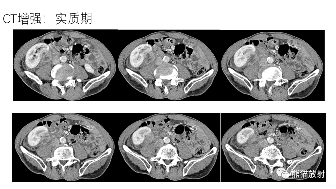 影像PPT - 【病例】肾（周）脓肿 VS 肾透明细胞癌-6