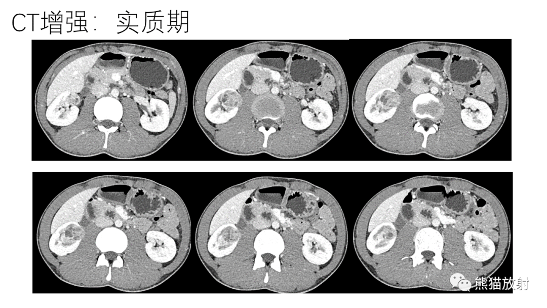 影像PPT - 【病例】肾（周）脓肿 VS 肾透明细胞癌-15