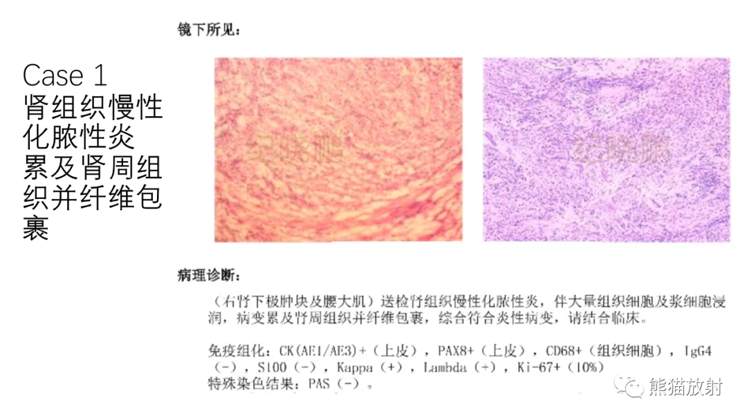 影像PPT - 【病例】肾（周）脓肿 VS 肾透明细胞癌-20
