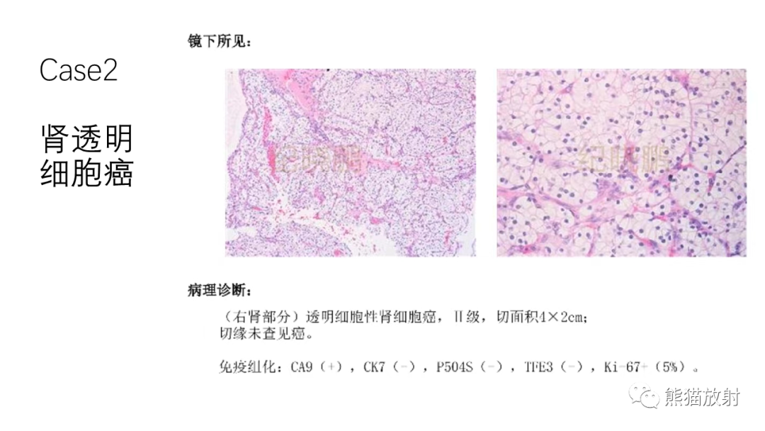 影像PPT - 【病例】肾（周）脓肿 VS 肾透明细胞癌-22