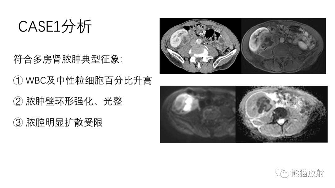 影像PPT - 【病例】肾（周）脓肿 VS 肾透明细胞癌-28