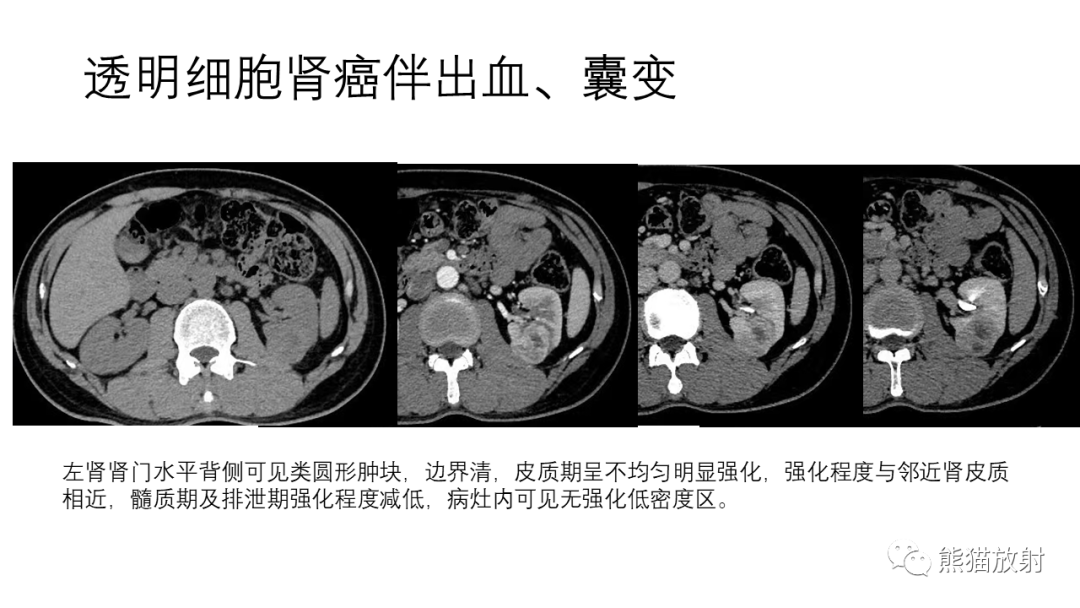 影像PPT - 【病例】肾（周）脓肿 VS 肾透明细胞癌-34