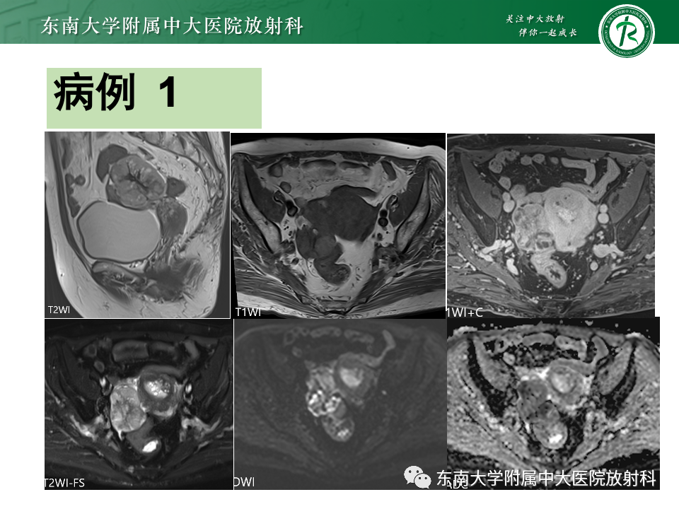 影像PPT - 【PPT】卵巢颗粒细胞瘤-3