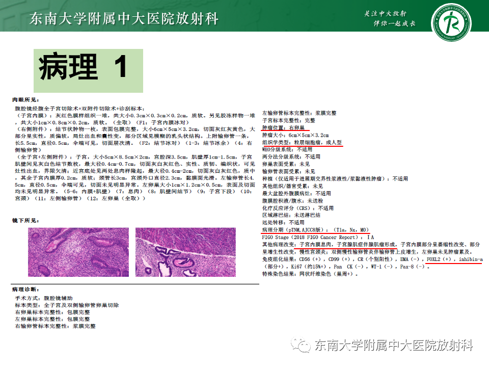 影像PPT - 【PPT】卵巢颗粒细胞瘤-4