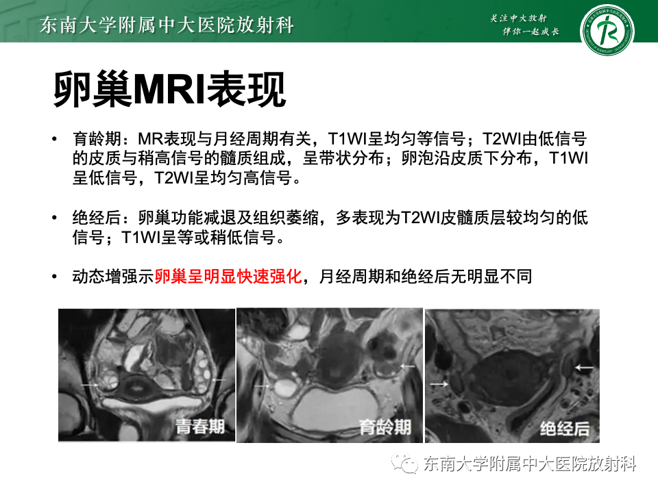 影像PPT - 【PPT】卵巢颗粒细胞瘤-8