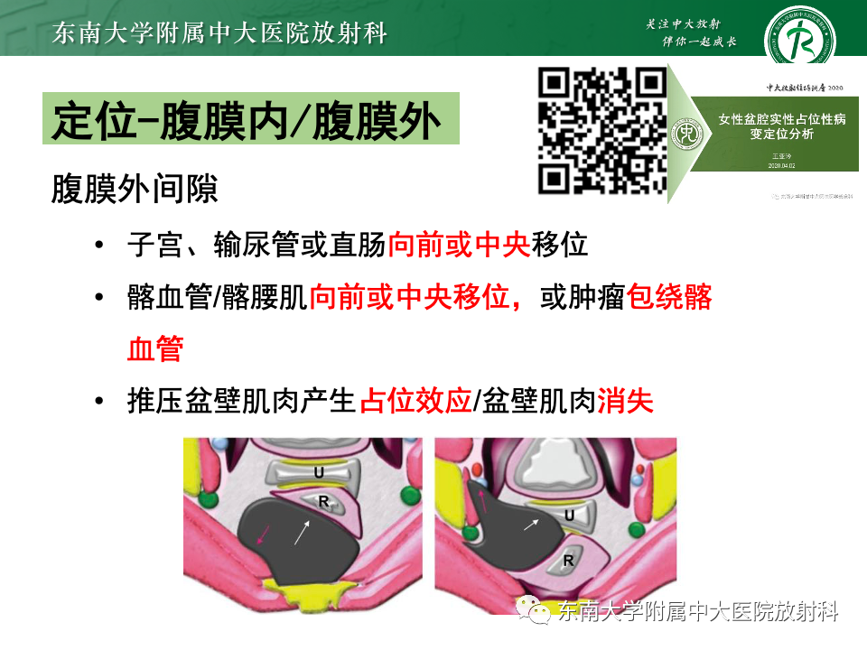 影像PPT - 【PPT】卵巢颗粒细胞瘤-10