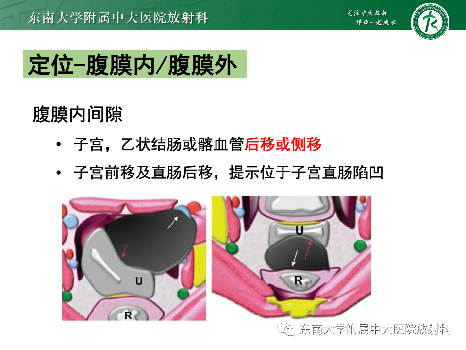 影像PPT - 【PPT】卵巢颗粒细胞瘤-11
