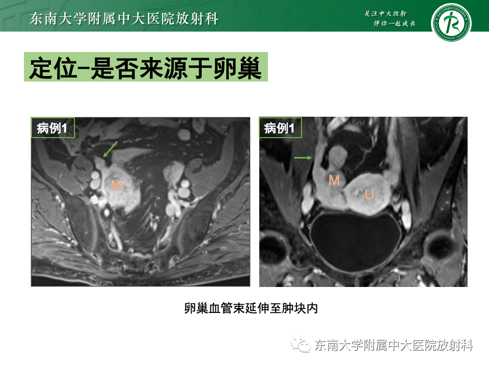 影像PPT - 【PPT】卵巢颗粒细胞瘤-13
