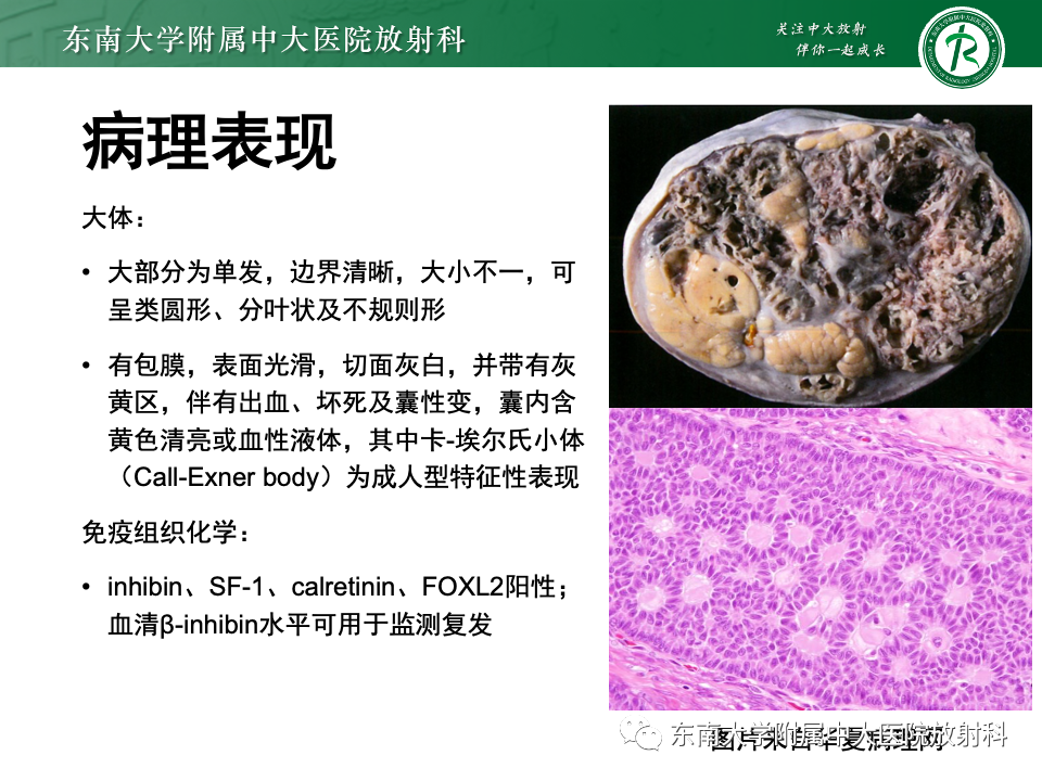 影像PPT - 【PPT】卵巢颗粒细胞瘤-17