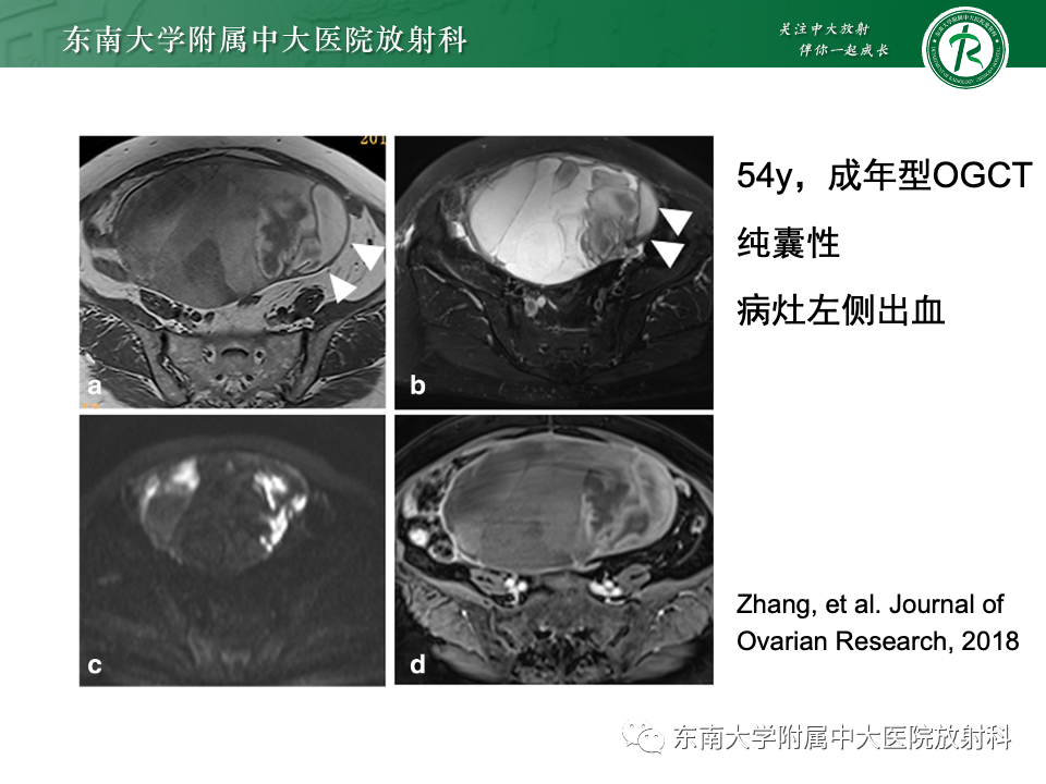 影像PPT - 【PPT】卵巢颗粒细胞瘤-21