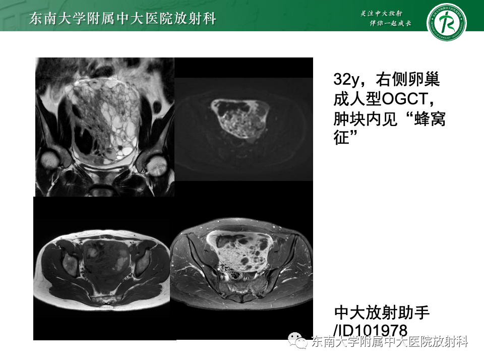 影像PPT - 【PPT】卵巢颗粒细胞瘤-22
