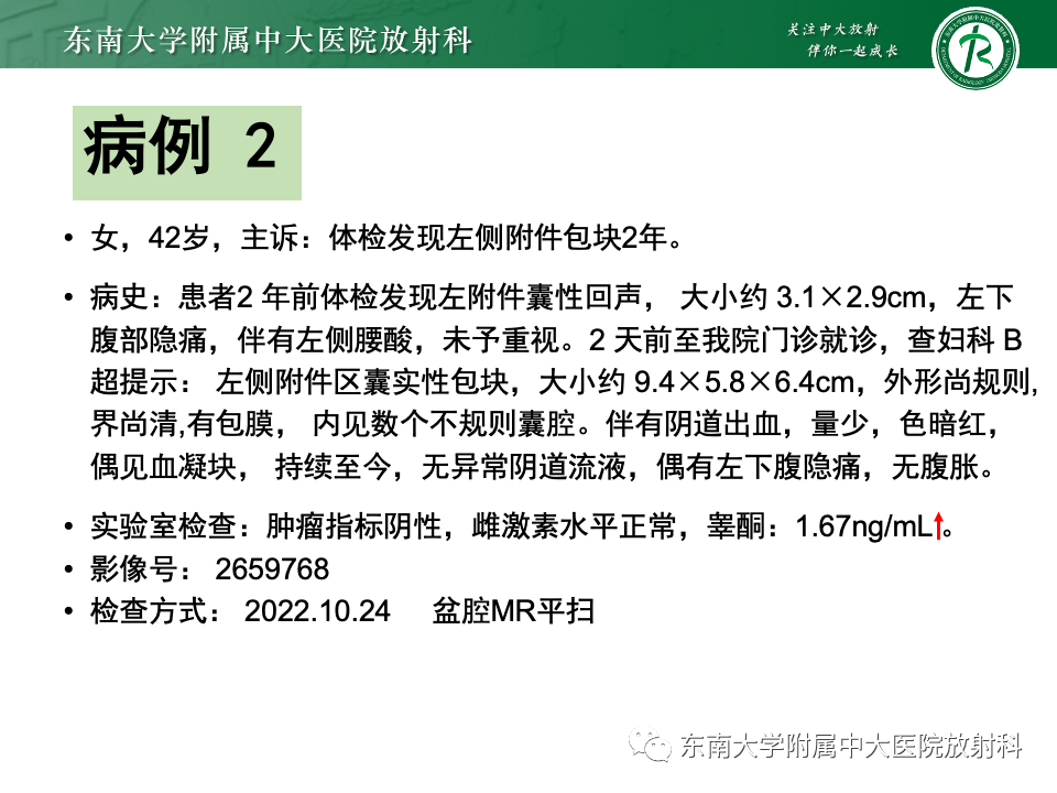 影像PPT - 【PPT】卵巢颗粒细胞瘤-23