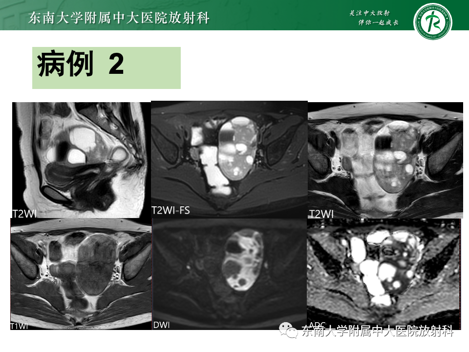 影像PPT - 【PPT】卵巢颗粒细胞瘤-24