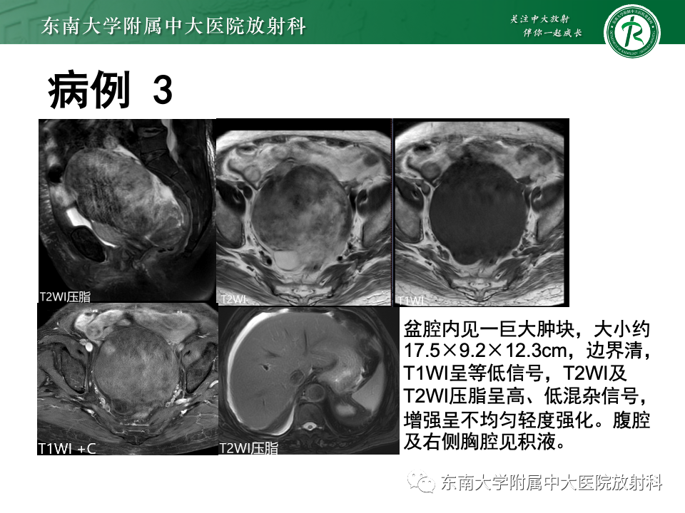 影像PPT - 【PPT】卵巢颗粒细胞瘤-28