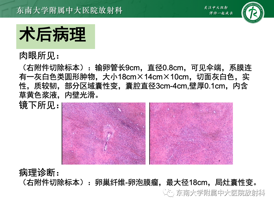 影像PPT - 【PPT】卵巢颗粒细胞瘤-29