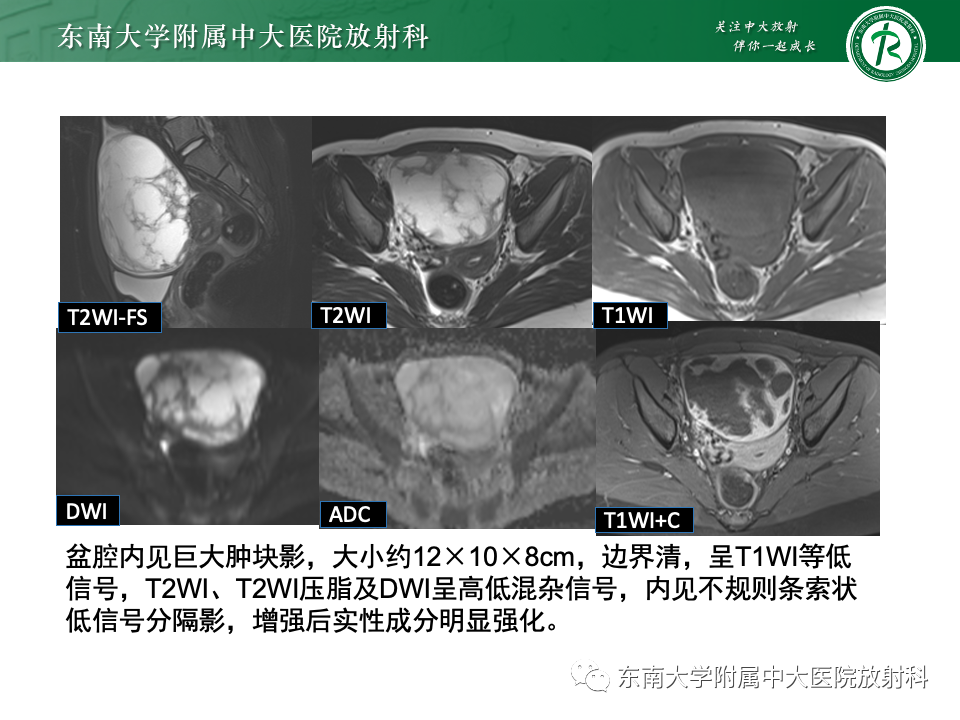 影像PPT - 【PPT】卵巢颗粒细胞瘤-35