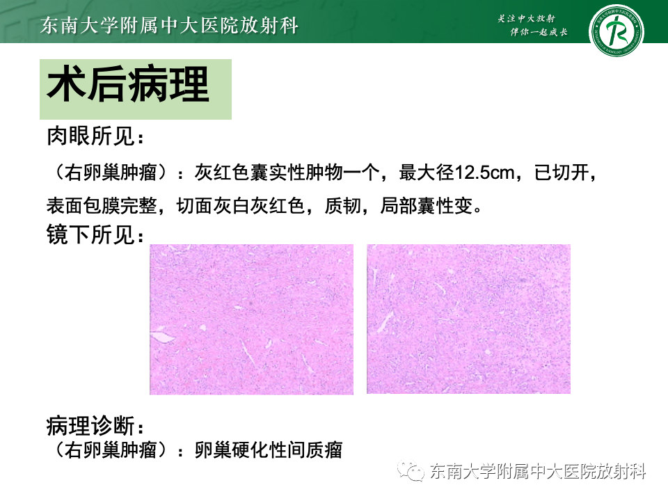 影像PPT - 【PPT】卵巢颗粒细胞瘤-36