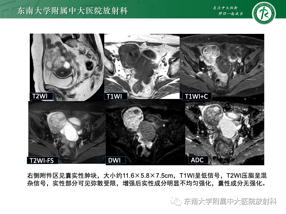 影像PPT - 【PPT】卵巢颗粒细胞瘤-39