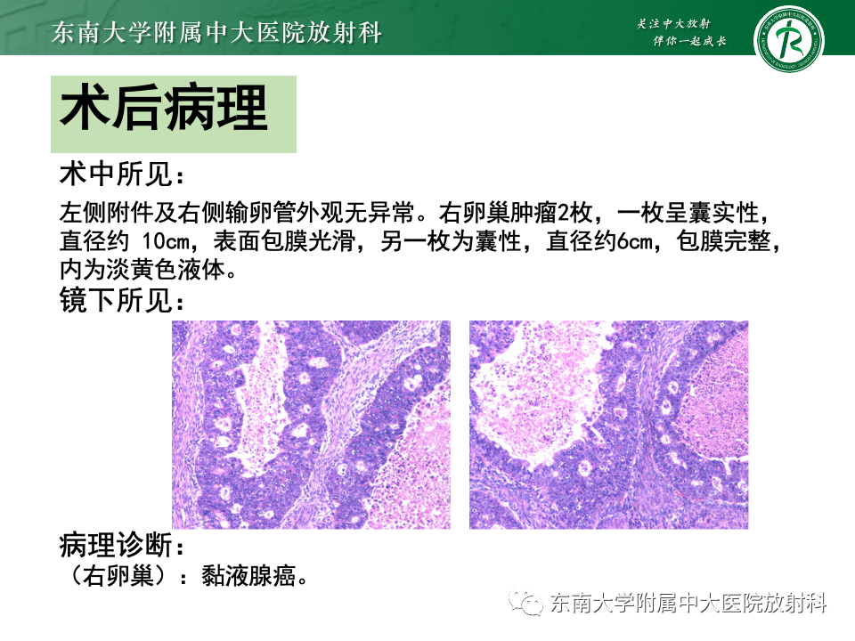 影像PPT - 【PPT】卵巢颗粒细胞瘤-40