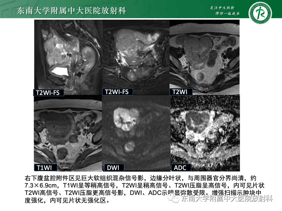 影像PPT - 【PPT】卵巢颗粒细胞瘤-44