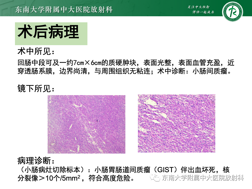 影像PPT - 【PPT】卵巢颗粒细胞瘤-45