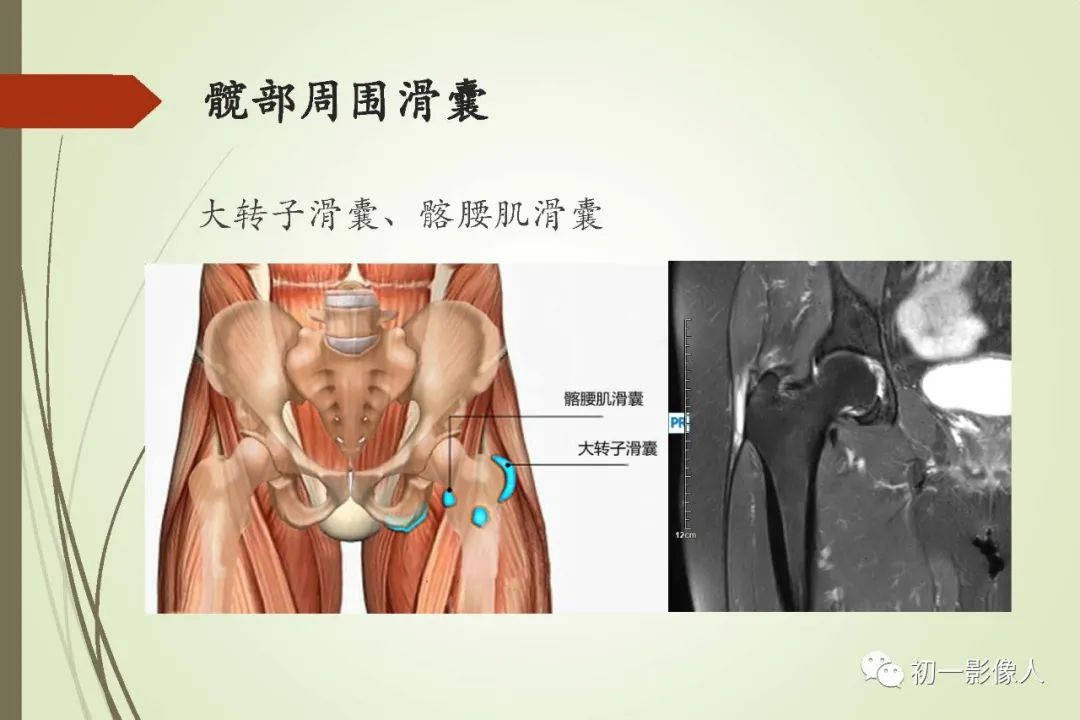 影像PPT - 大转子疼痛综合征2例MR影像-3