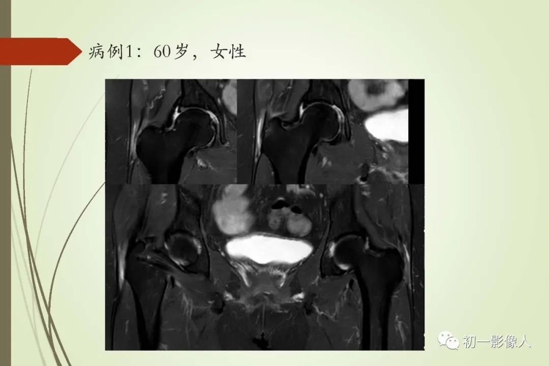 影像PPT - 大转子疼痛综合征2例MR影像-5