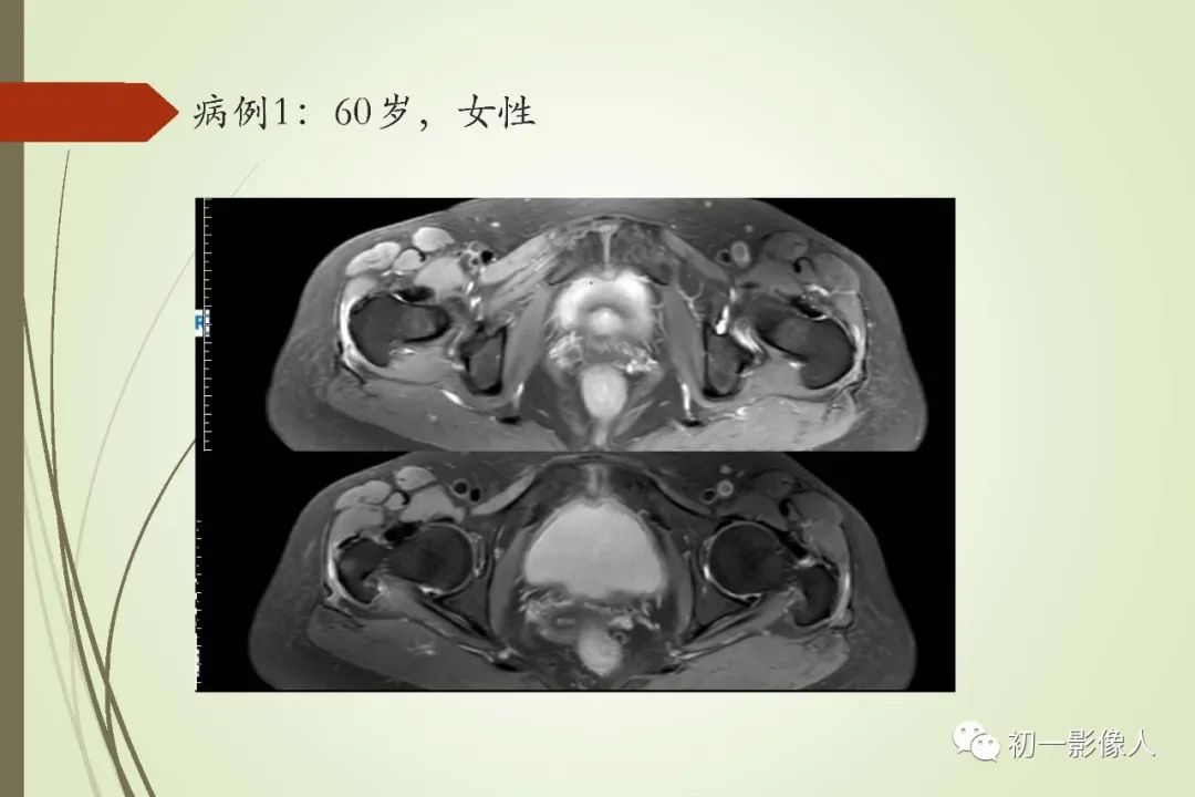 影像PPT - 大转子疼痛综合征2例MR影像-6