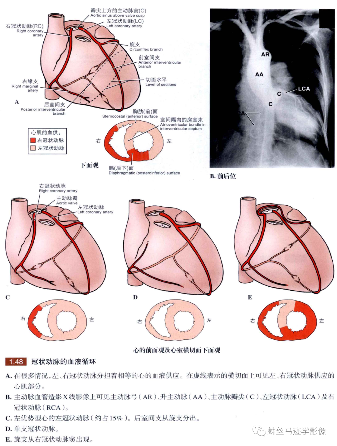影像PPT - 冠状动脉详细解剖及变异-8