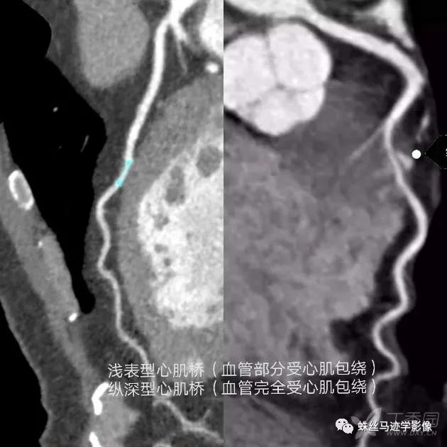 影像PPT - 冠状动脉详细解剖及变异-14