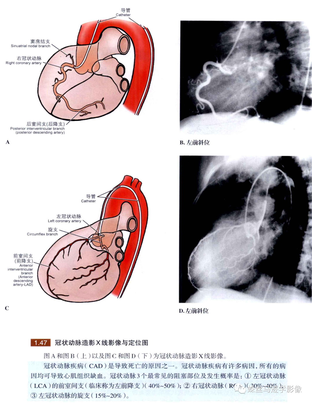 影像PPT - 冠状动脉详细解剖及变异-15