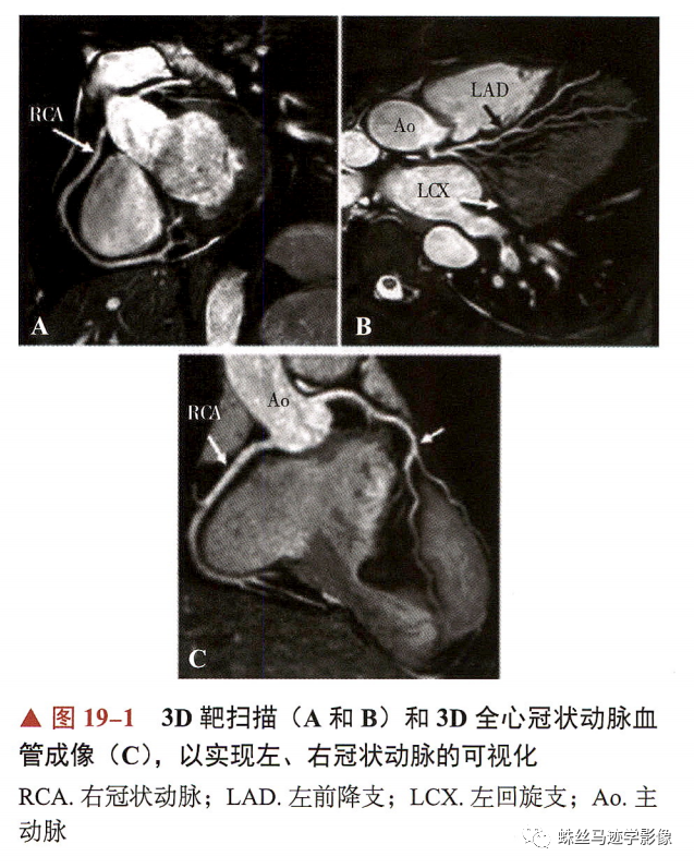 影像PPT - 冠状动脉详细解剖及变异-18