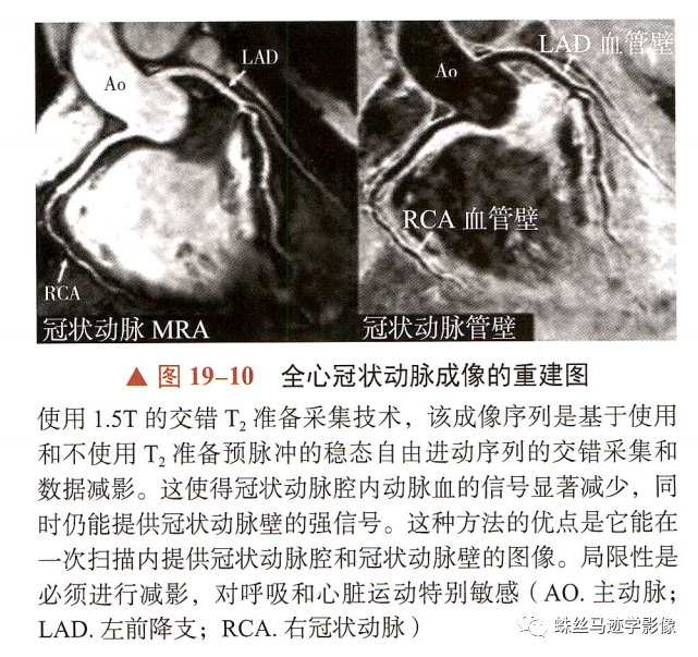 影像PPT - 冠状动脉详细解剖及变异-20