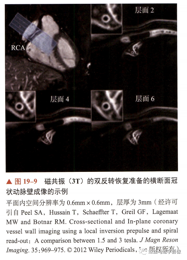 影像PPT - 冠状动脉详细解剖及变异-21
