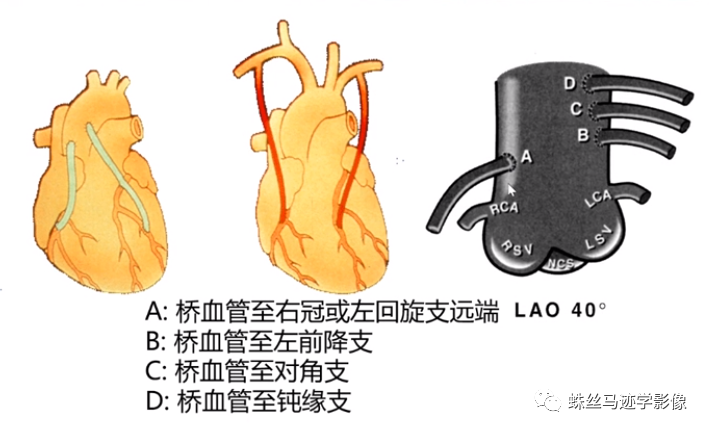 影像PPT - 冠状动脉详细解剖及变异-23