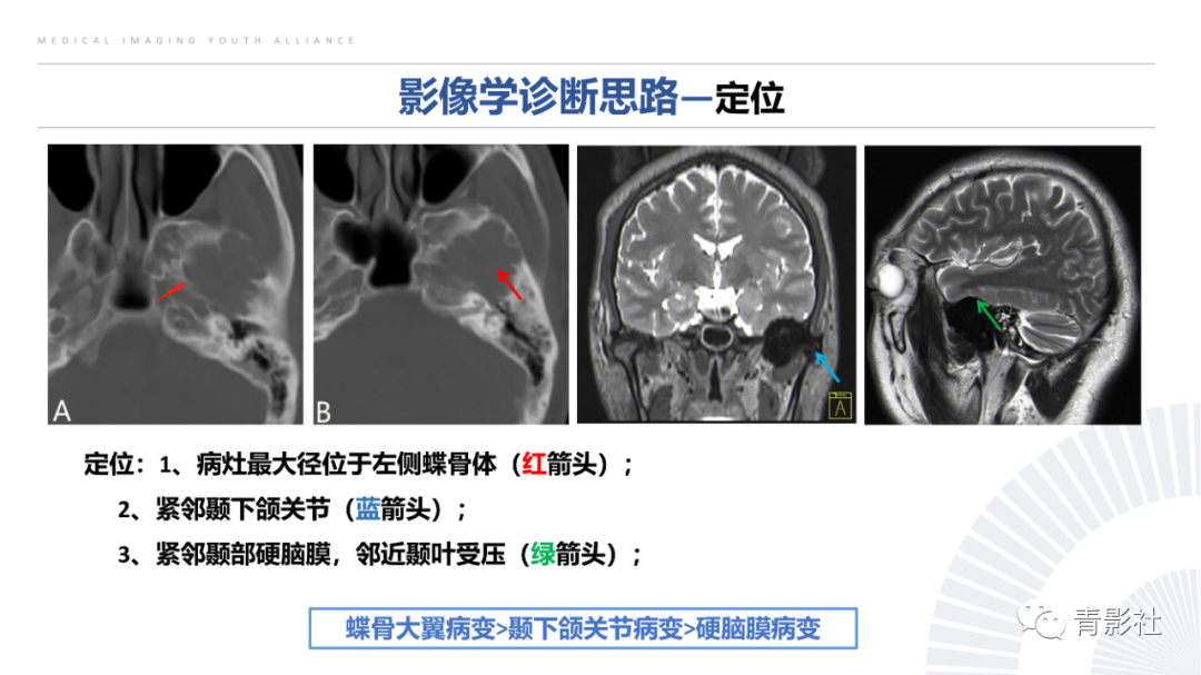 影像PPT - 【病例】蝶骨巨细胞修复性肉芽肿1例CT及MR影像-9