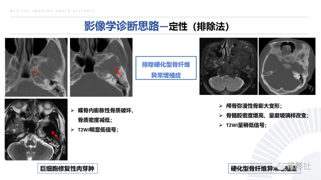 影像PPT - 【病例】蝶骨巨细胞修复性肉芽肿1例CT及MR影像-13