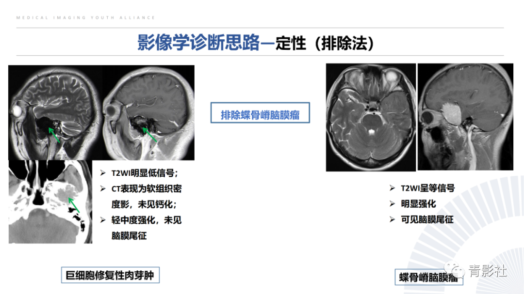 影像PPT - 【病例】蝶骨巨细胞修复性肉芽肿1例CT及MR影像-12