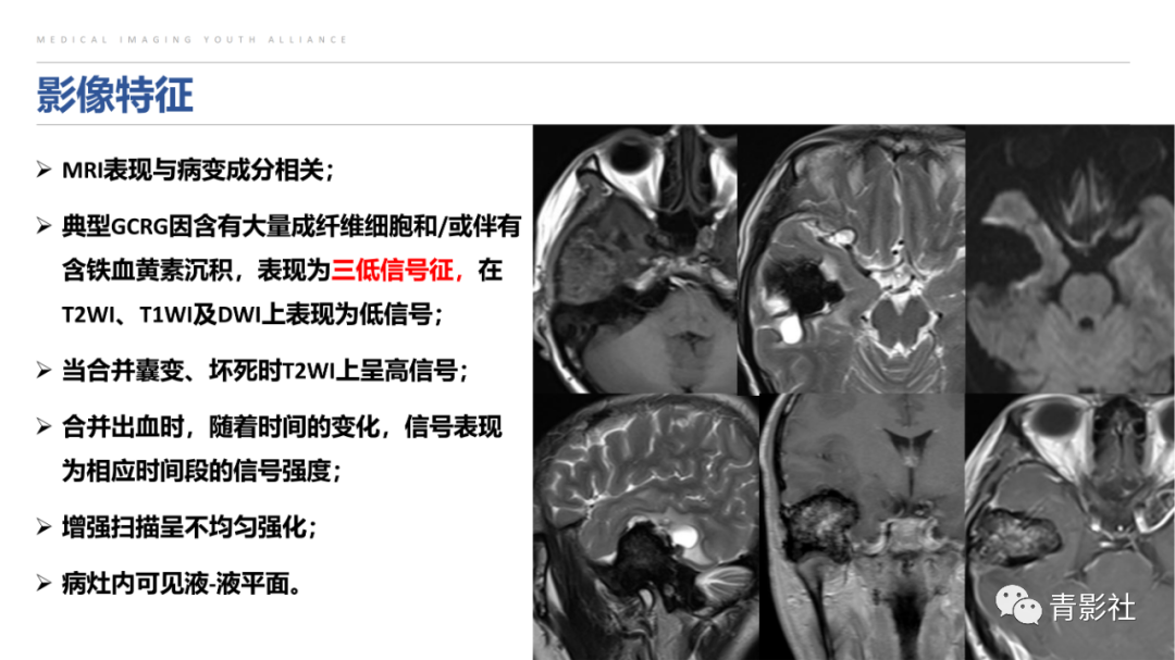 影像PPT - 【病例】蝶骨巨细胞修复性肉芽肿1例CT及MR影像-19