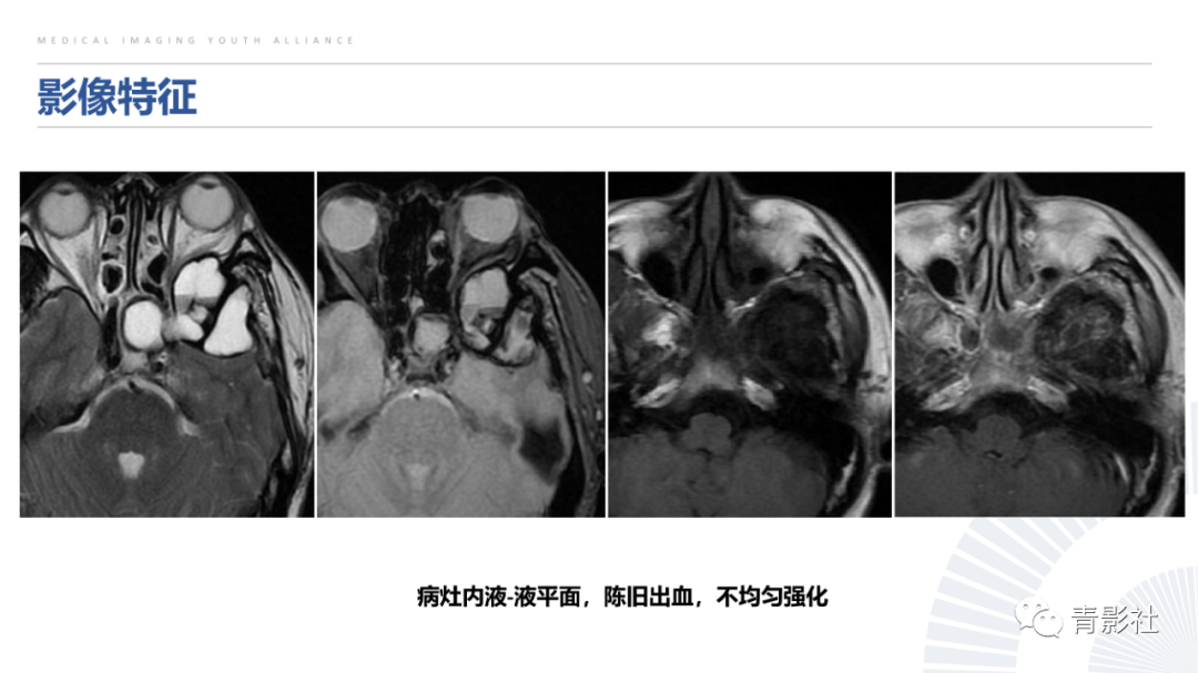 影像PPT - 【病例】蝶骨巨细胞修复性肉芽肿1例CT及MR影像-20