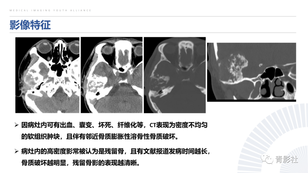 影像PPT - 【病例】蝶骨巨细胞修复性肉芽肿1例CT及MR影像-18