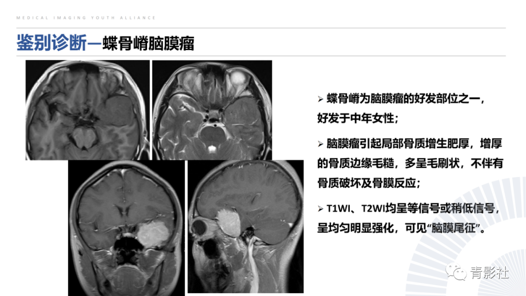 影像PPT - 【病例】蝶骨巨细胞修复性肉芽肿1例CT及MR影像-24