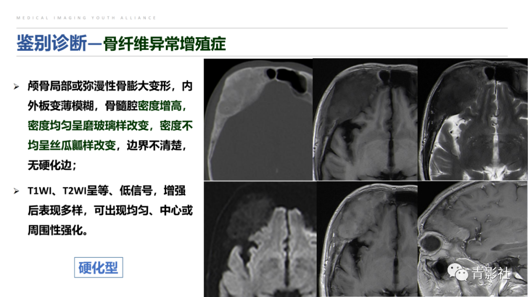 影像PPT - 【病例】蝶骨巨细胞修复性肉芽肿1例CT及MR影像-22