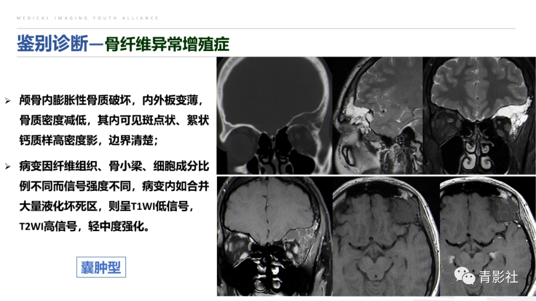 影像PPT - 【病例】蝶骨巨细胞修复性肉芽肿1例CT及MR影像-23