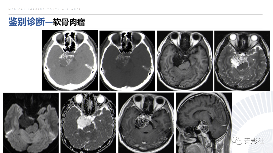 影像PPT - 【病例】蝶骨巨细胞修复性肉芽肿1例CT及MR影像-26