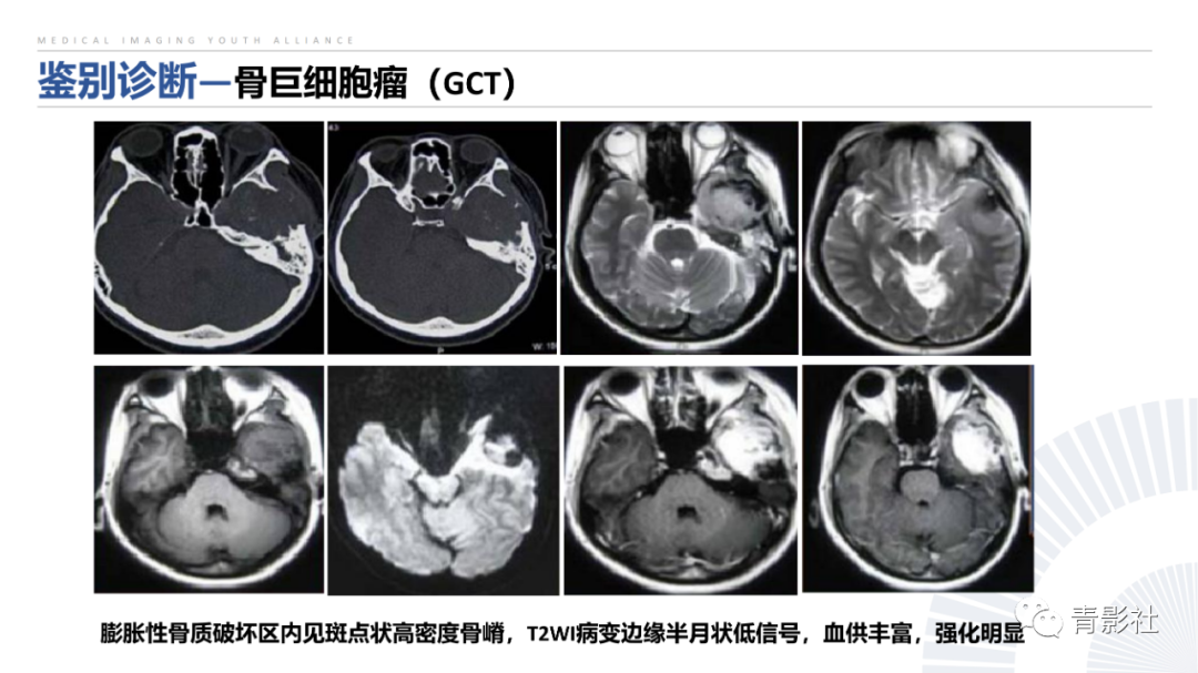 影像PPT - 【病例】蝶骨巨细胞修复性肉芽肿1例CT及MR影像-28