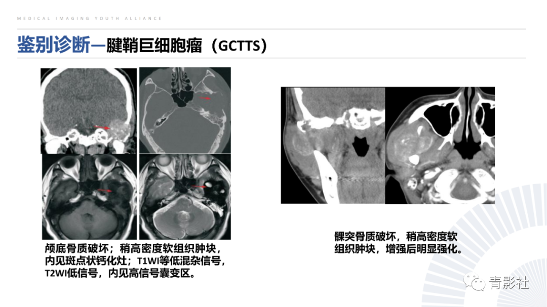 影像PPT - 【病例】蝶骨巨细胞修复性肉芽肿1例CT及MR影像-30