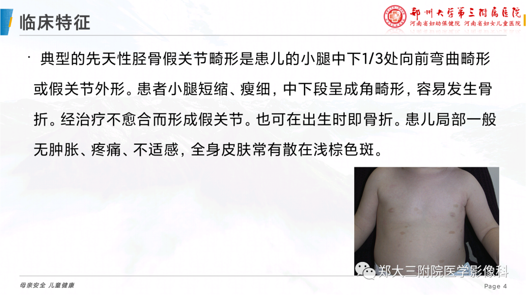 影像PPT - 【PPT】儿童先天性胫骨假关节-4