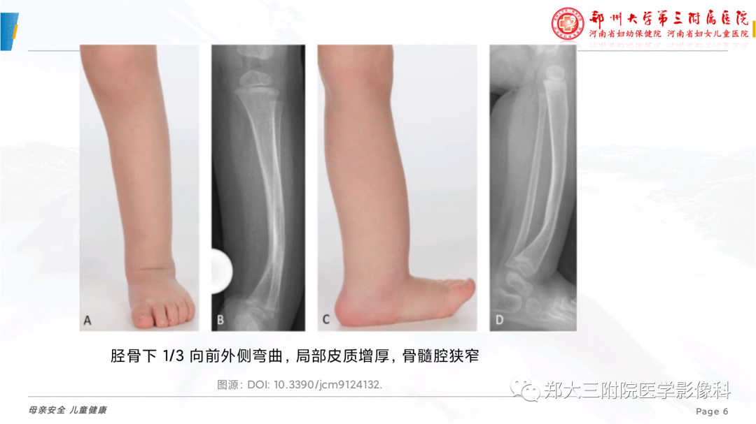影像PPT - 【PPT】儿童先天性胫骨假关节-6