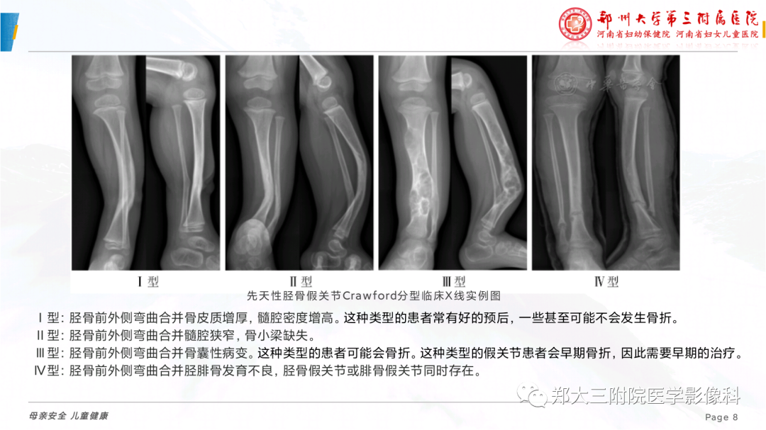 影像PPT - 【PPT】儿童先天性胫骨假关节-8